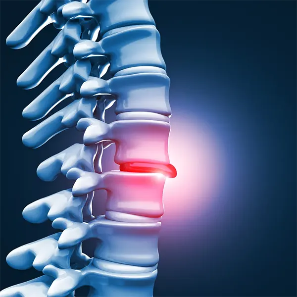 Disc Injury Treatment Near Me in Fayetteville, NC. Chiropractor For Disc Injury Pain Relief.